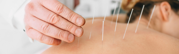 acupuncture needles placed in spine