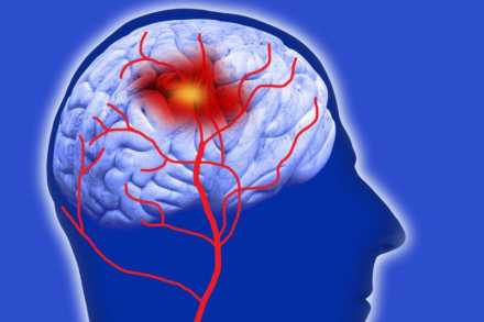 illustration of stroke in blood vessels of the brain