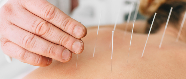 acupuncture needles in back